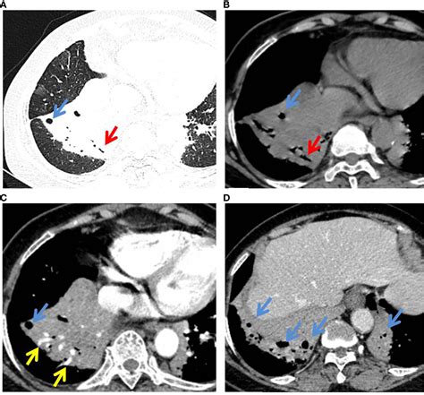 Frontiers Evaluation Of Ct Features For Differentiating Consolidation