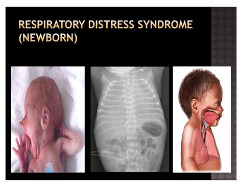 respiratory distress syndrome newborn