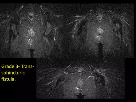 Presentation Pptx Peri Anal Fistula PPTX