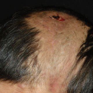 Ulcerated Lesion With Purulent Discharge Of The Scalp Figure