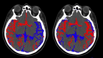 Radiology Artificial Intelligence On Twitter Cerebral Arteries And