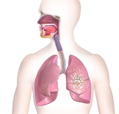 Las 3 diferencias entre neumonía y bronquitis