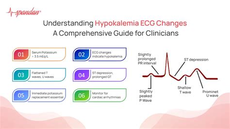 Understanding Hypokalemia ECG Changes A Guide For Doctors