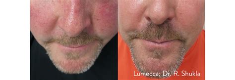 Before After Plastic Surgery In Knoxville Tn Premier Surgical