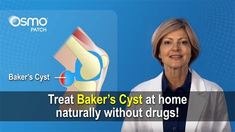 Baker S Cyst Treatment What You Need To Know YouTube