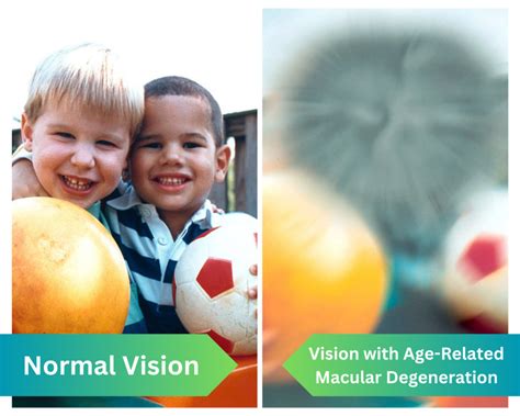 Gene Therapy Solutions For Age-Related Macular Degeneration - William A ...