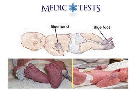 Acrocyanosis Bluish Hands And Feet Acrocyanosis Is Normal And Is