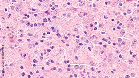 Microscopic Image Of Disseminated Histoplasmosis A Type Of Fungal