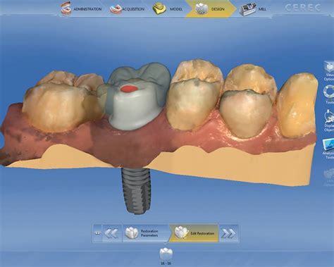 Cadcam Workflow For Implant Using Cerec System Aie Implant