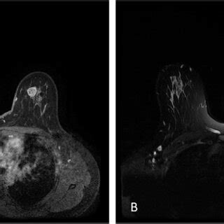 Axial T2 Weighted A And Axial Post Contrast Image B Demonstrate A