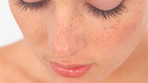 manchas en la piel del sol