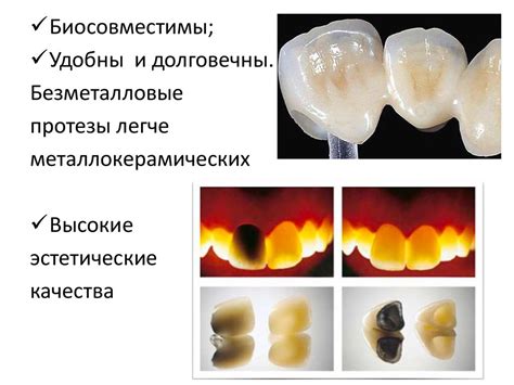 Стоматологическая керамика. Фарфор - презентация онлайн