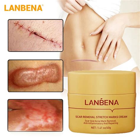 LANBENA Scar Removal Cream Acne Treatment Repairing Scar Shopee Singapore