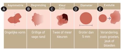 Herken Huidkanker Polikliniek Dermatologie Ceulen Klinieken