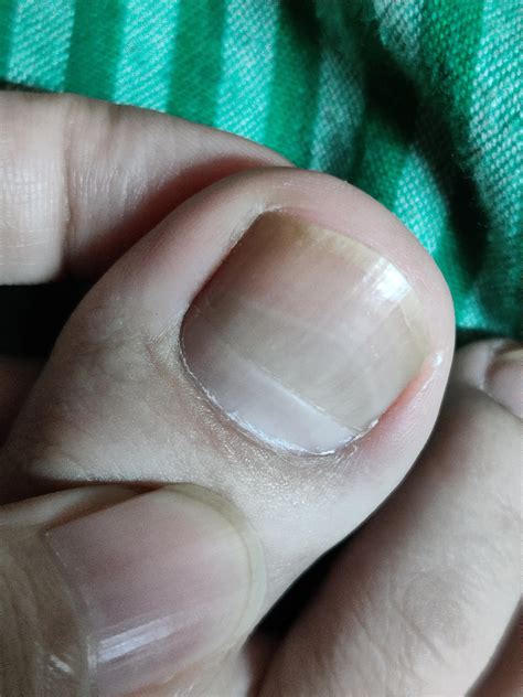 Yellow layer on my big toe nail. Fungal? No pain though. | Scrolller