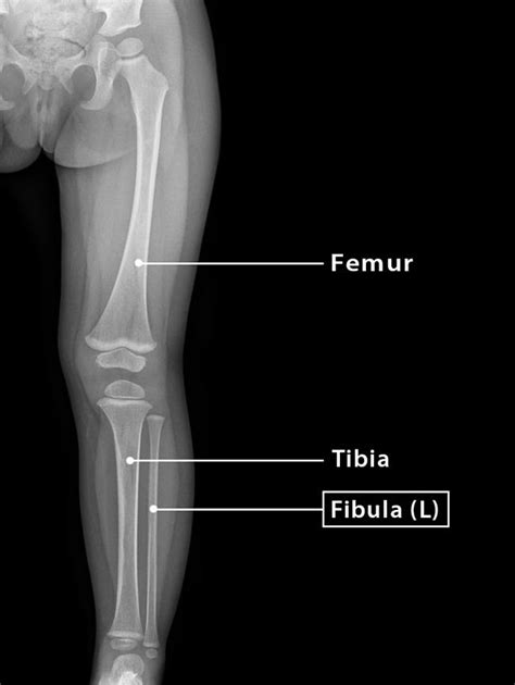 Styloid Process Of Fibula