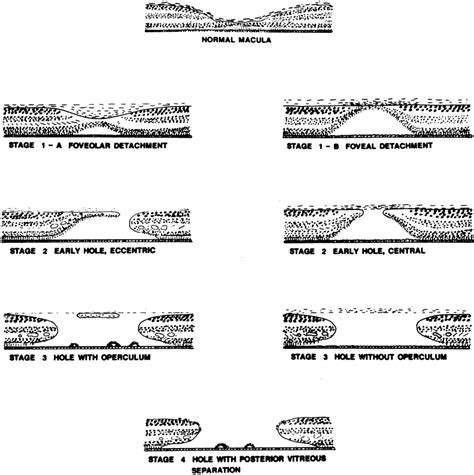 Macular Hole Stages