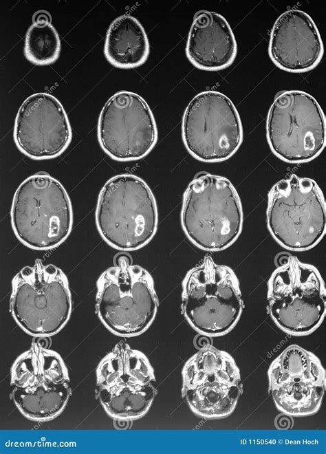 Tumor Cerebral No Mri Foto De Stock Imagem