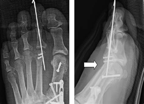 A Guide To Performing An Effective Weil Osteotomy