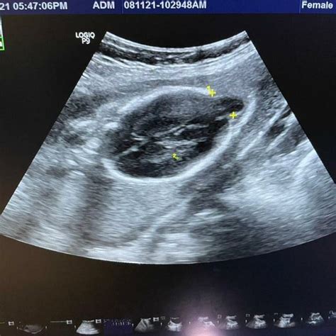 Diagnosis Of Acrania A Partial Absence Of The Skull Bones Seta
