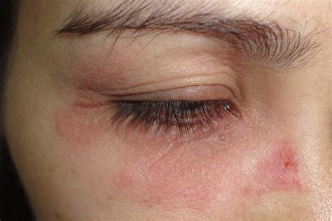 periocular rash  bmj