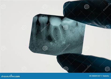 granuloma  ray stock image image  denture scan