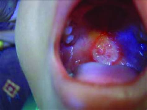 Typical Tubercular Ulcer With Flat And Granular Base And Undermined