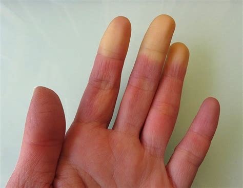 Sindromul Raynaud Remediu I Tratament Vitta Clinic