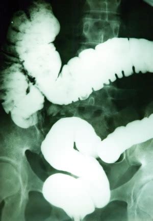 prepare  adverse contrast medium reactions knowledge  key