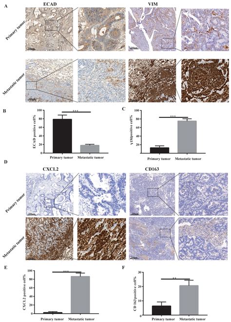 Lung Metastases Have Prominent Mesenchymal Features And Secrete Cxcl