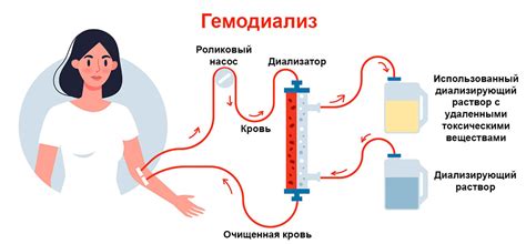 На диализе что это такое простыми словами