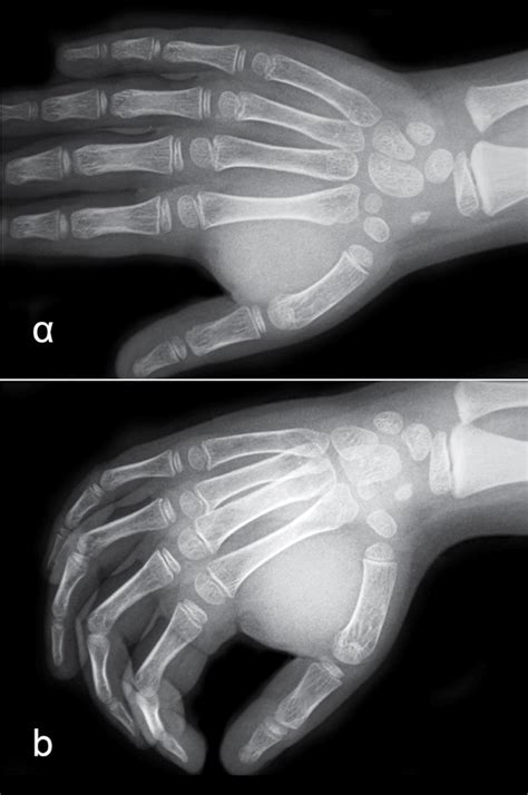 A Anteroposterior And B Lateral Preoperative Radiographs Of The