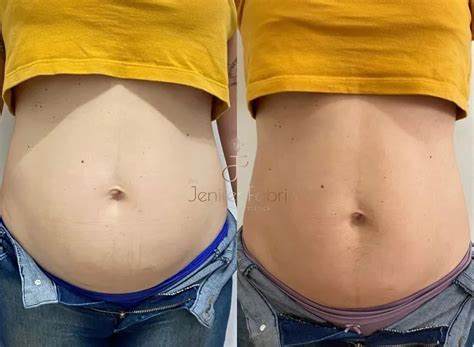 Hidrolipo Antes E Depois