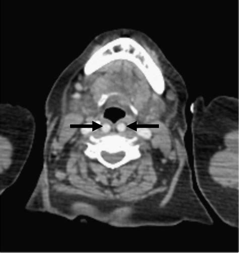 Incidental Detection Of High Riding Innominate Artery And Bilateral