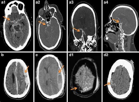 Examples Of Subarachnoid Subdural And Epidural Hematoma Arrows