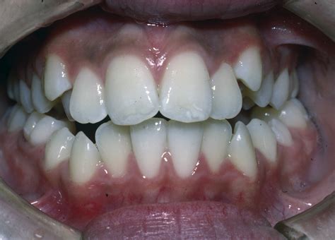 Bite and Alignment Correction – Smile Creations - Dr. Steinberg