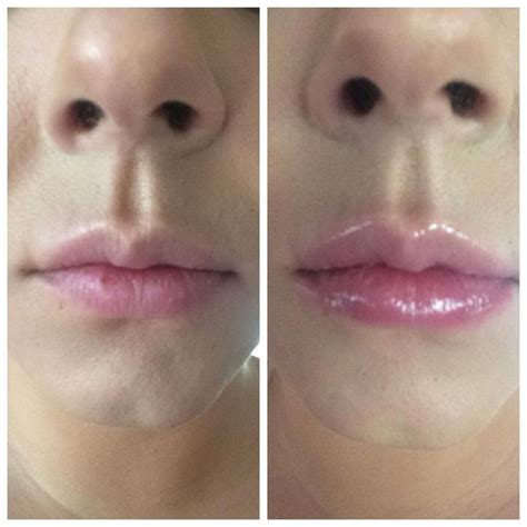 My Before And After Using The Toofaced Extreme Lip Injections Gloss I