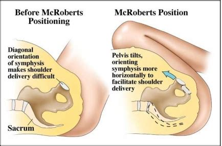 Shoulder Dystocia Woods Screw Maneuver