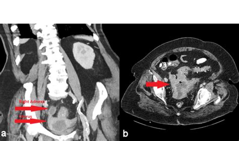 Transvaginal Ultrasound Tvus A Of The Uterus In The Sagittal Plane Download Scientific