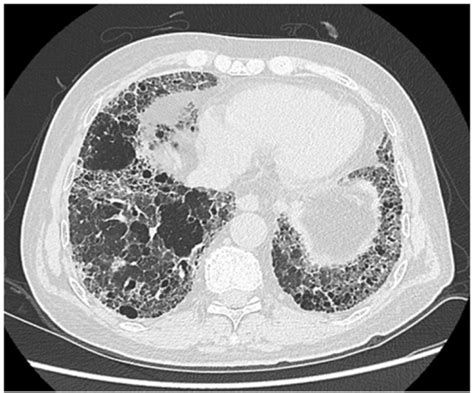 Idiopathic pulmonary fibrosis. High-resolution CT scan | Open-i