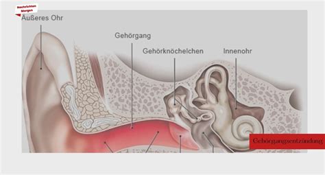 Gehörgangsentzündung Ursachen Symptome und Behandlung