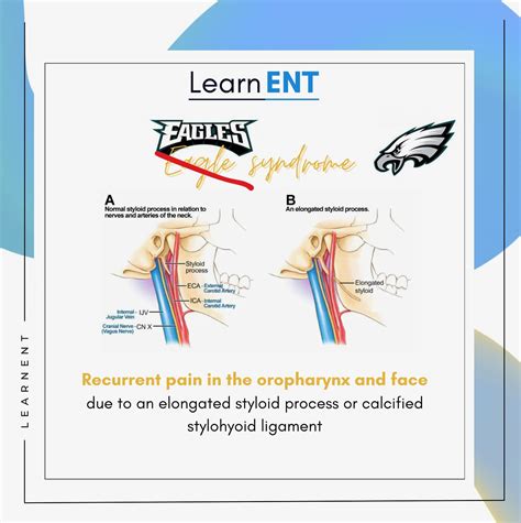 LearnENT | Peritonsillar abscess: when a sore throat turns serious ⚠ ...