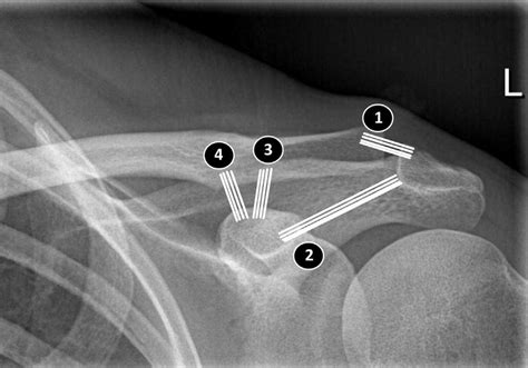 Schema Of Ligaments Acromioclavicular Ligament Coracoacromial