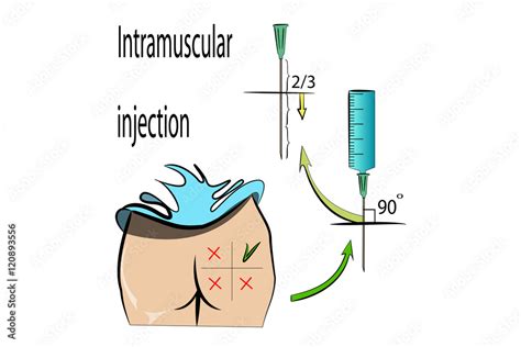 rules for intramuscular injection Stock Vector | Adobe Stock