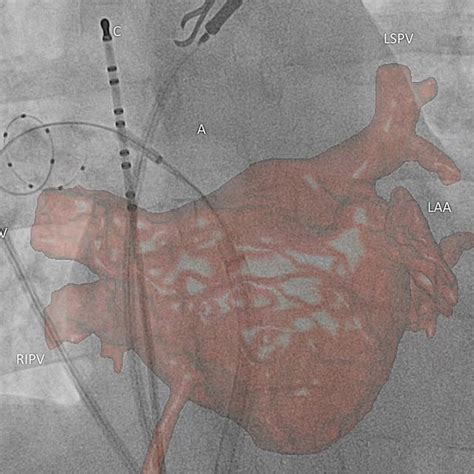 Reconstructed Image Overlay On Live Fluoroscopy Screen The Cryoballoon Download Scientific