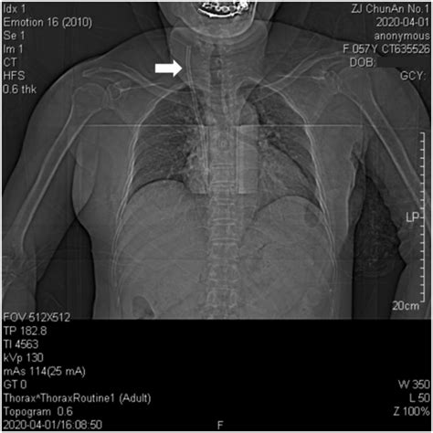 Chest X Ray Showing The Fractured Catheter Arrow In The Right Atrium