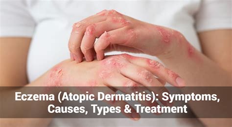 Eccema dermatitis atópica síntomas causas tipos y tratamiento