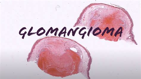 Glomangioma Glomuvenous Malformation Glomus Tumor With Lots Of Vessels