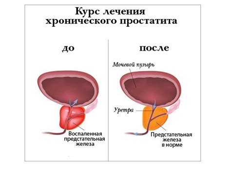 Везикуло простатит: этиология, симптомы и лечение