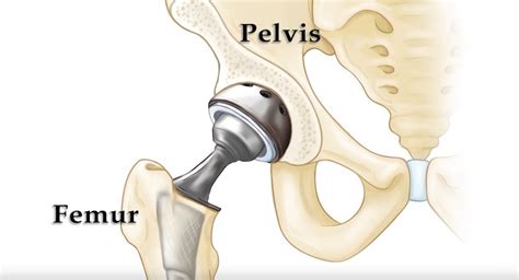 Hip Replacement Jeremy Latham